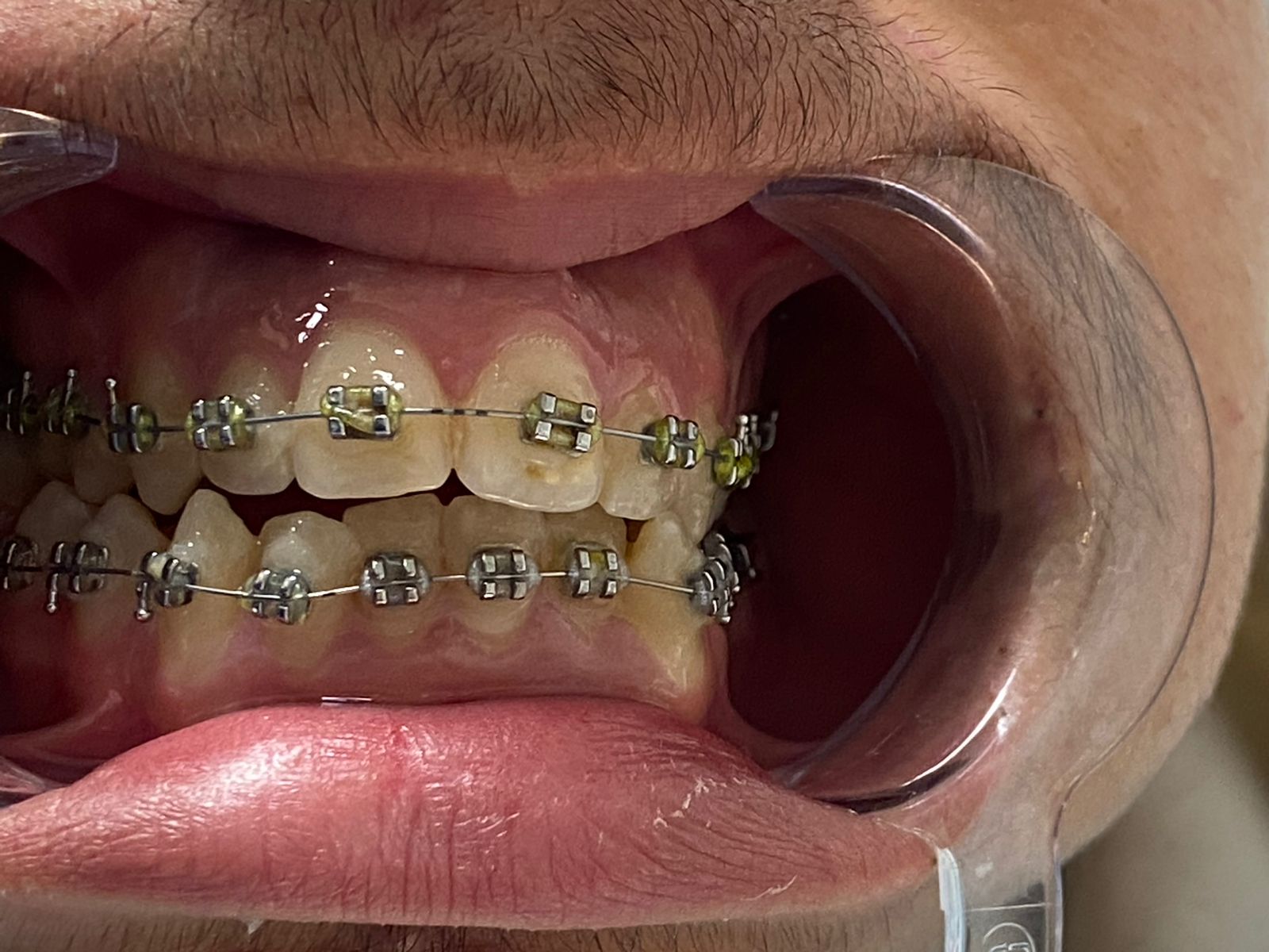 Deuxième cas d'orthodontie suivi par le Dr Moumen El Mehdi à Casablanca